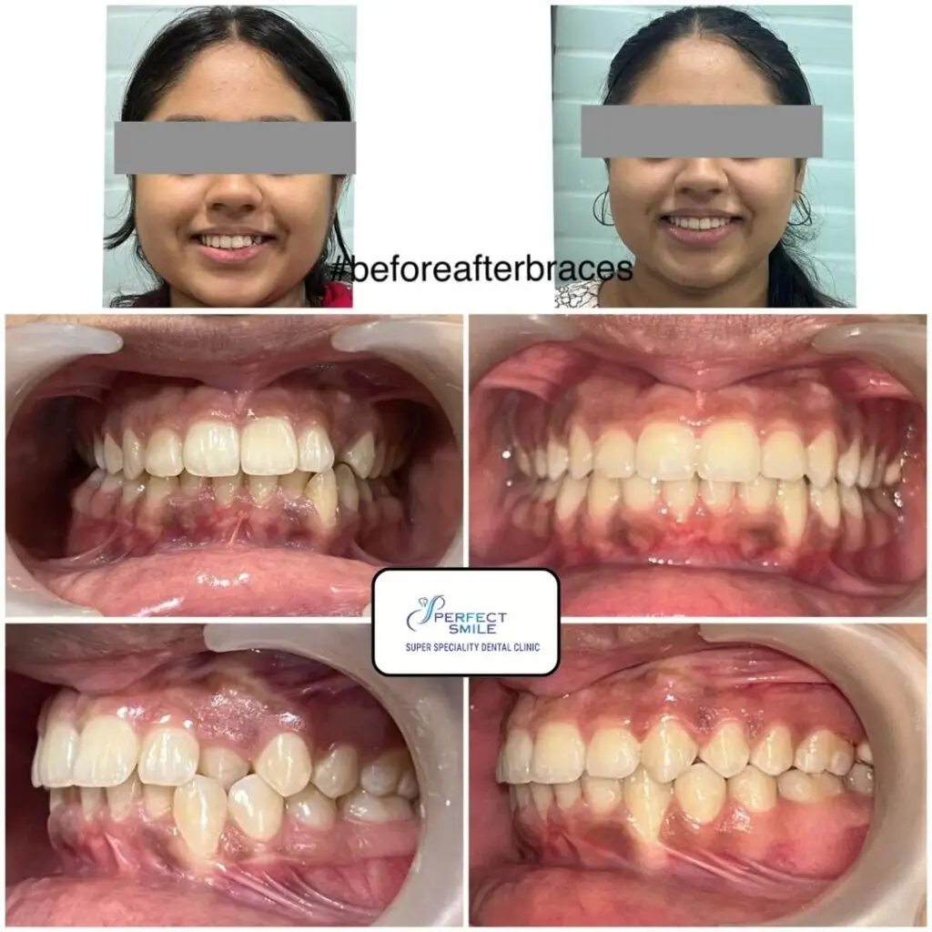 Before and after braces treatment in Burdwan showing perfect teeth alignment by Dr. Archana Bhagat at Perfect Smile Super Speciality Dental Clinic.
