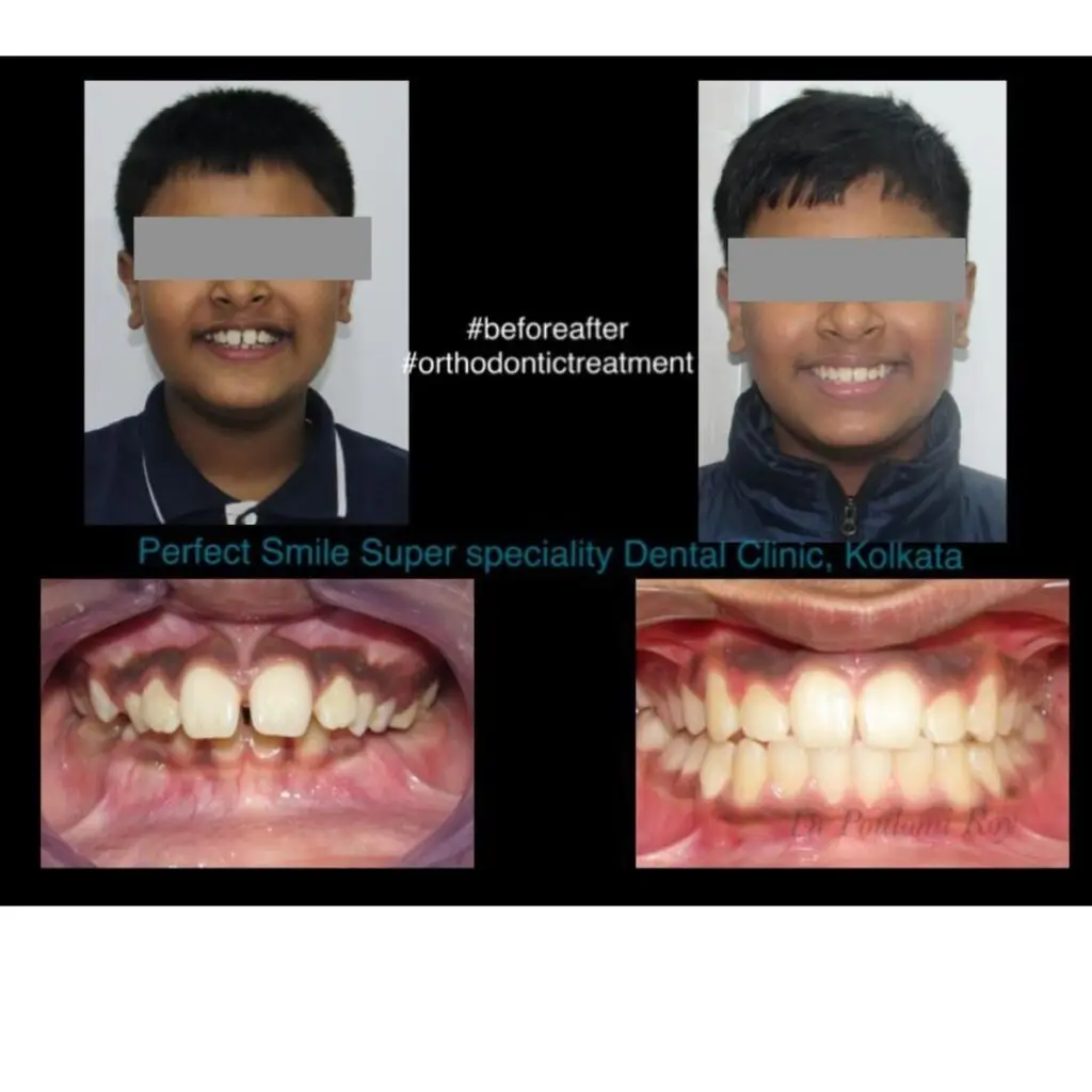 Before and after braces treatment in Kolkata revealing excellent alignment and bite correction results.