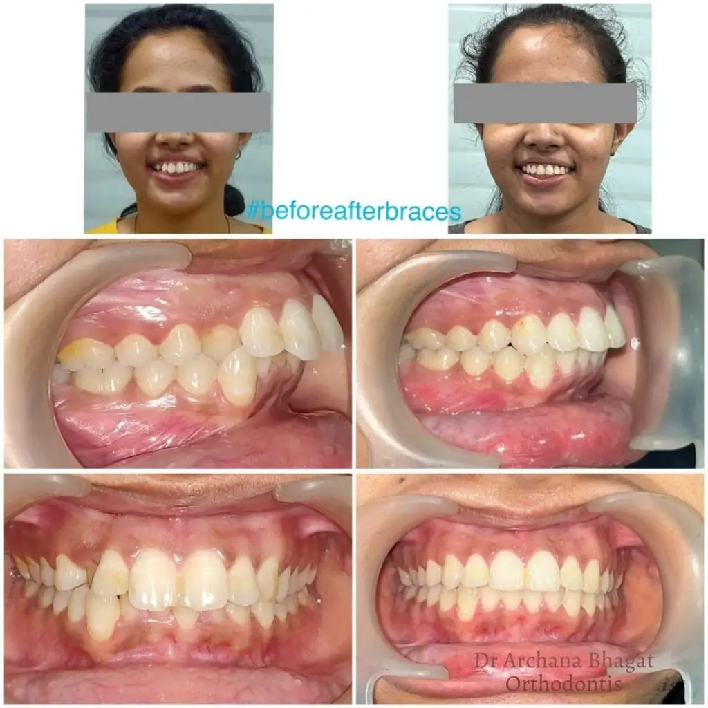 Braces treatment in Kolkata before and after transformation with improved smile alignment and bite correction.