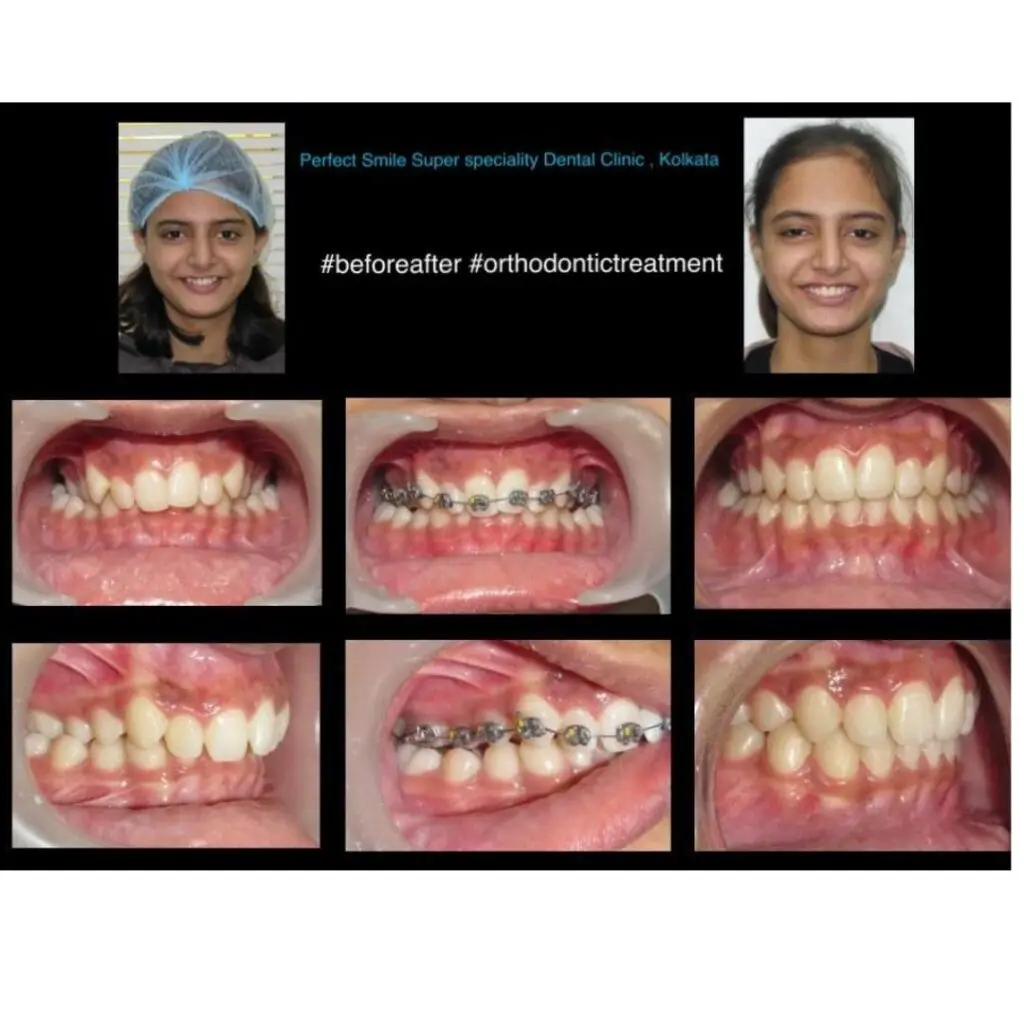 Close-up before and after photo showing braces treatment in Kolkata and improved dental aesthetics.