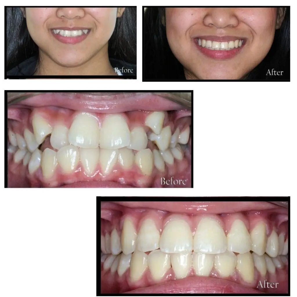 Orthodontic results from braces treatment near me showing straightened teeth and confident smile.