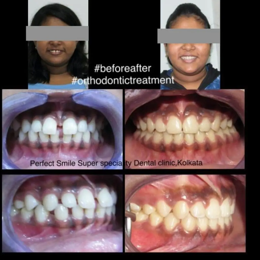Perfect smile achieved through braces treatment in Burdwan by Dr. Archana Bhagat, Orthodontist & Dento-facial Orthopaedics.