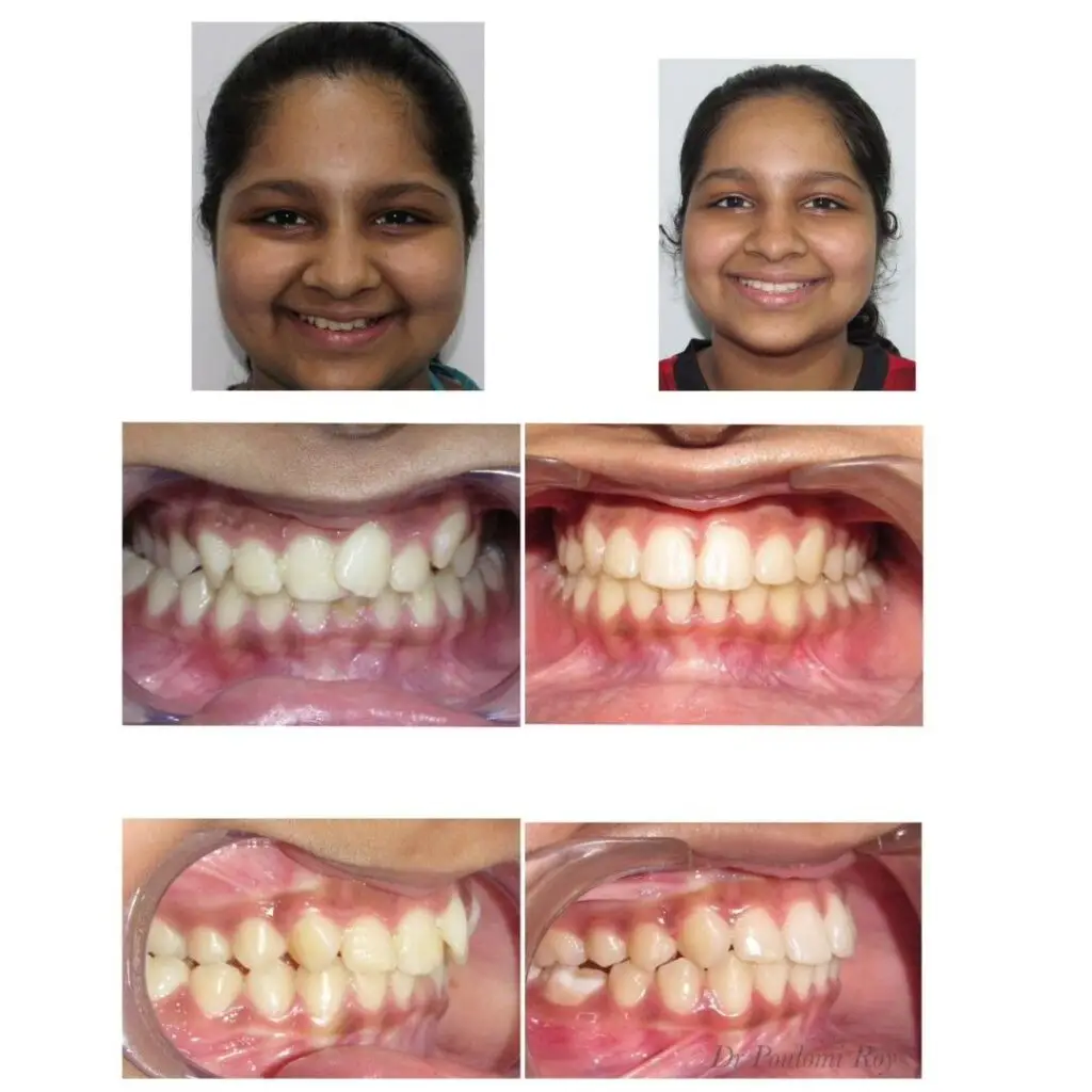 Teeth alignment improvement after 22-month braces treatment in Burdwan by experienced orthodontist Dr. Archana Bhagat.